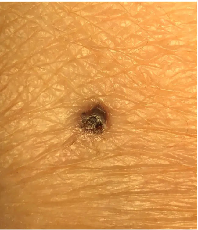 Figure 3.1. Clinical image of a nodular basal cell carcinoma localized on the arm.  