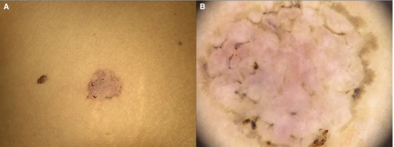 Figure 1.1. A) A round pink patch with a pigmented edge, located on the trunk of a 39-