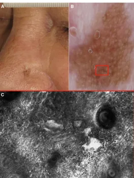 Figure 1.2. A) Clinical picture of a 68-year-old man with a lentigo maligna of the nose