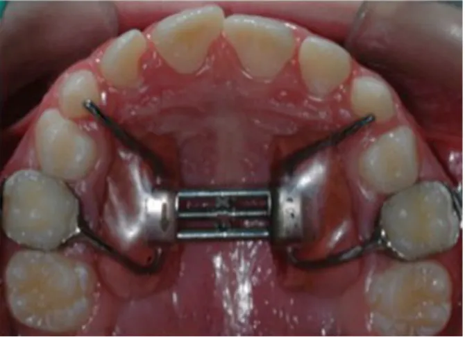 Figure 2. Modified Haas-type expander anchored to deciduous teeth. 
