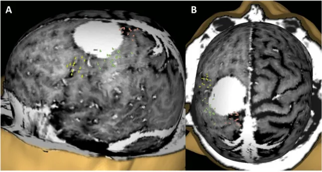 Figure 1: Example of the nTMS cortical mapping of the M1 in lateral (A) and cranio-caudal views  (B) in a patient with a “rolandic” meningioma