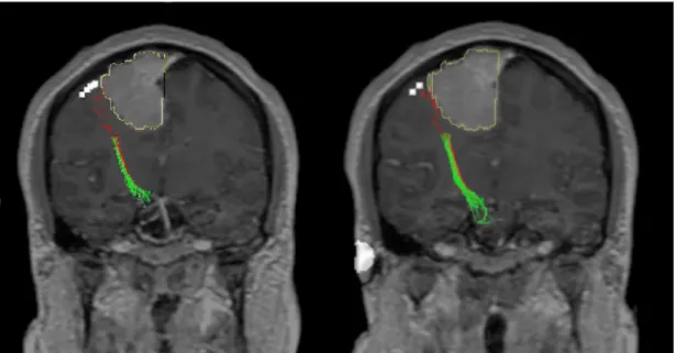Figure  2:  Example  of  the  nTMS-based  DTI-FT  of  the  CST  in  coronal  view  in  a  patient  with  a  parasagittal Rolandic  meningioma