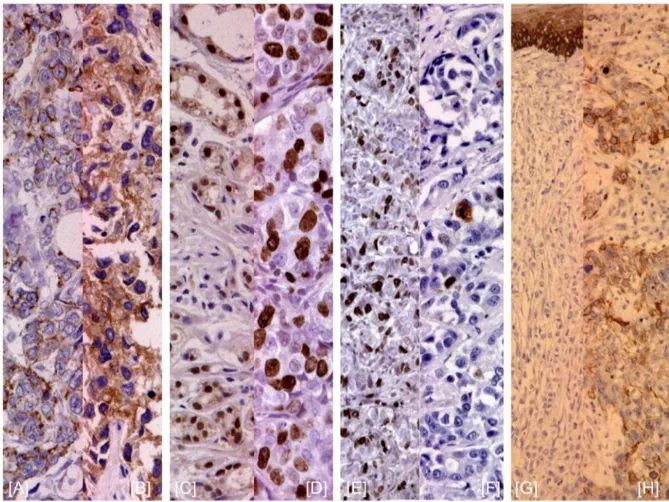 Figure 1: E-Cadherin, Ki67, AR, and CK5/6 expression by IHC.  (A, B) E-cadherin negative/positive staining; (C, D) Ki-67 level  &lt; or ≥ 20%;  (E, F) negative/positive AR staining; (G, H) negative/positive CK5/6 staininig.