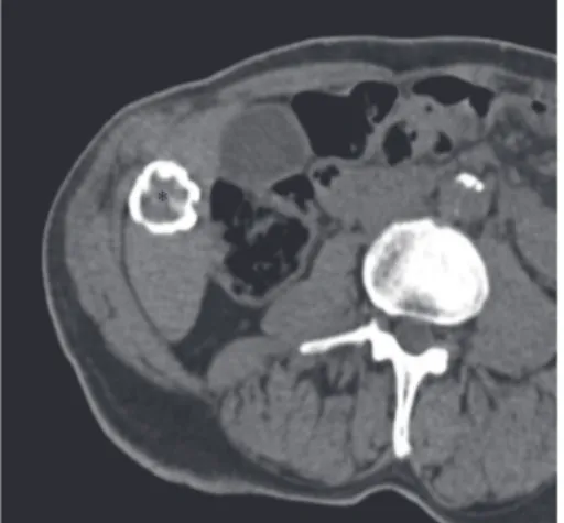 Figure 1: Axial unenhanced CT-scan performed a few years before the superinfection shows the hepatic hydatid cyst (asterisk) with calcified wall in segment VI.