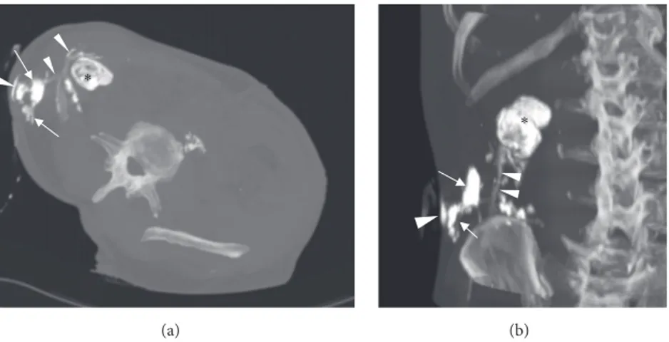 Figure 3: Axial oblique (a) and coronal (b) MIP reformatted CT-fistulography. The injection of the contrast agent through the external opening of the fistula allowed identifying the abscess (arrows) and the whole fistulous tract (arrowheads) ascending to t