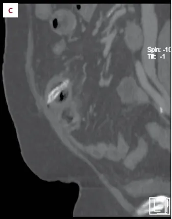 Figure 2.   Axial-oblique ( A ) and sagittal ( B ) contrast-enhanced  CT scan with soft-tissue windowing demonstrating  a small amount of free air (arrow) adjacent to the  thickened loop, as the sign of intestinal perforation