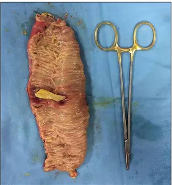 Figure 3.   Surgical specimen of the ileal loop resected with the  goat ossicle.