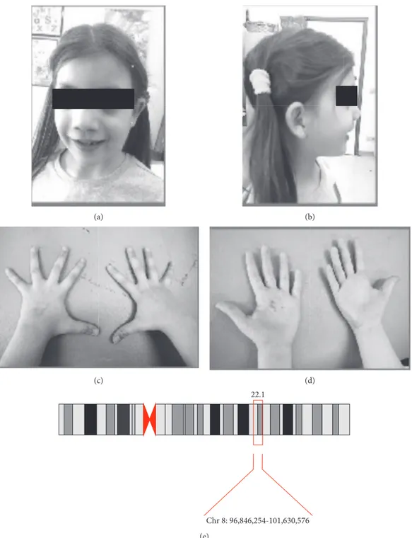 Figure 1: (a, b) Facial picture of the 8-year-old girl showing facial dimorphism: ﬂat face, blepharophimosis, hypertelorism, broad nasal bridge, and high palate