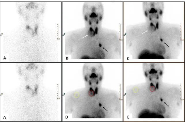 Figure  1.Panel  A:  99m Tc-pertechnetate  thyroid  scintigraphy  was  obtained 20  minutes  after  tracer  administration  (111  MBq)  using  dual  headed  gamma-camera  [Brightview-X  (Philips,  Cleveland,  USA)]  equipped  with  Low  Energy  High  Resol