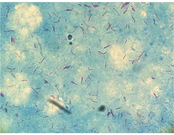 Fig. 2. Acid-fast bacilli in a Ziehl–Neelsen stain of needle aspira- aspira-tion material from the lesion.