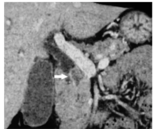 Figure 1. Contrast-enhanced CT with bidimensional reconstruction showed a suspect intraluminal obstruction with the upper dilatation (12 mm) of the choledochal duct (arrow).