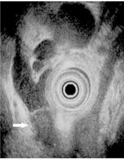 Figure 2. Magnetic resonance cholangiopancreatography indicated a round polypoid mass in the distal biliary tract and confirmed that