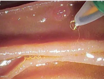 Fig. 2 Loop-tip wire outside the sphincterotome before cannulation of