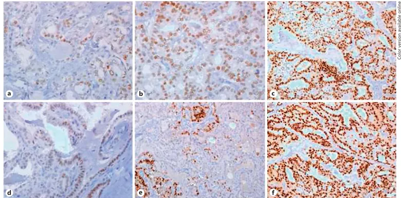 Fig. 1.   Immnunohistochemical ER-α ( a–c ) and PR ( d–f ). The intensity of expression (brown color) progressively 