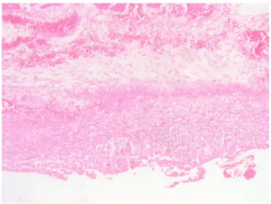 Figure 4: Subtotal colectomy.  Enterocolitis due to ipilimumab. Large bowel wall with necrosis and lymphocytic and leucocytic  infiltration.