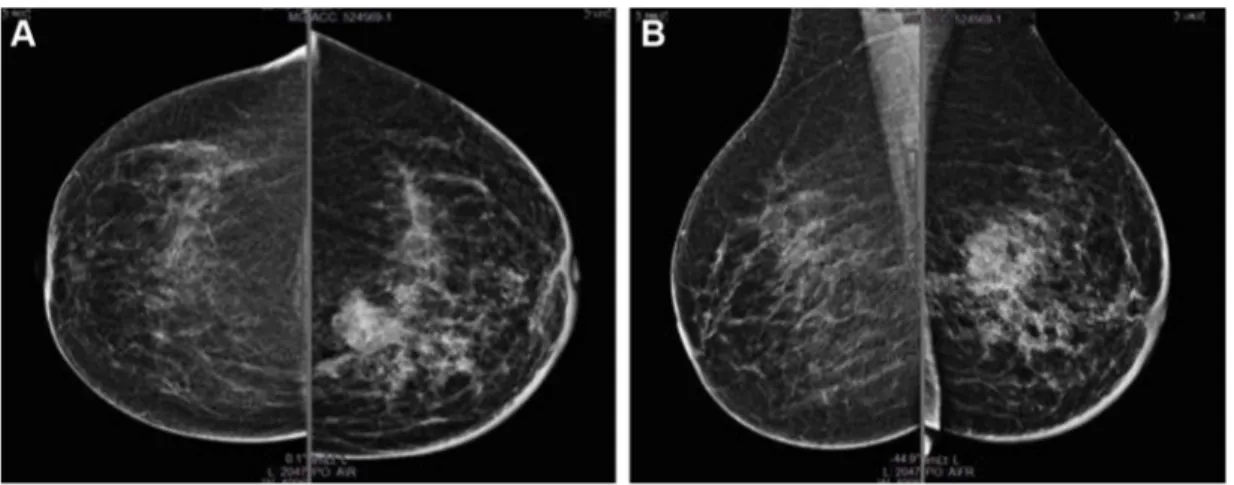 Figure 1 May 2015, baseline mammography.
