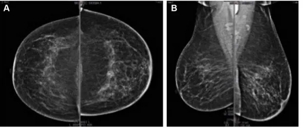 Figure 2 september 2015, mammography after neoadjuvant therapy. Note: (A) craniocaudal and (B) mediolateral oblique projections.