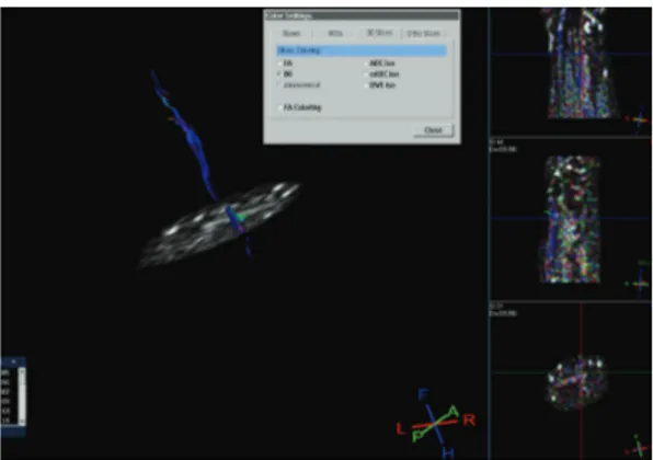 Figure 2: Fiber-tracking reconstruction of median nerve shows an anatomical visualization of the fibers which are oriented from proximal to distal direction, as expected (in blue)