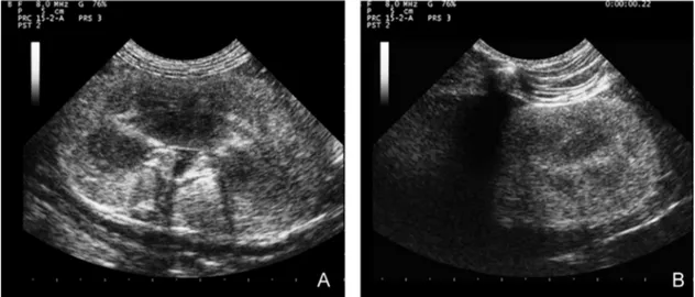 Fig. 4. Abdominal ultrasound images of the renal parenchyma (right and left kidneys): noticeable increase in the echogenicity of the renal parenchyma, with a loss of deﬁnition of the corticomedullary line, slight bilateral pyelectasis.