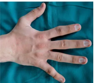 Figure  1:  Physical  examination  showing  skeletal  abnormalities  (pectus  excavatum  and  left  hand)  and  darkening  of  the  skin of  the  lateral thorax 