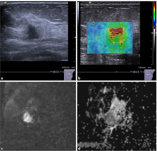 Fig. 1 A 48-year-old woman with invasive  duc-tal breast cancer, G3. The lesion (dashed circle) presents as an ill-defined hypoechogenic lesion on B-mode ultrasound (a) that is associated with high SWV (4.6 m/s), coded red on the parametric ARFI  over-lay 