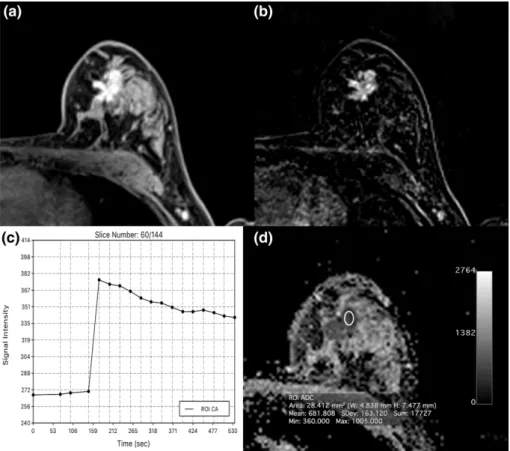 FIGURE 3: Invasive ductal carcinoma (IDC) grade 3 retroareolar in the left breast in a 47-year-old woman: On DCE-MRI there is a 23-mm (A) irregularly shaped and partly spiculated mass with (B) an initial fast heterogeneous contrast enhancement followed by 