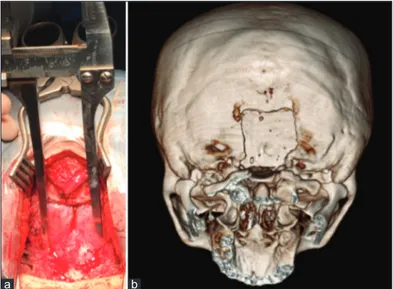 Figure 1: (a) e image shows the 3 cm × 3 cm craniectomy and the  removal of the most median third of the posterior arch of C1, (b)  ree-dimensional computed tomography scan reconstruction demonstrates  the suboccipital craniectomy and removal of the most