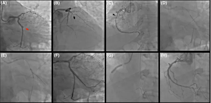 FIGURE 1  Primary Intervention: thrombotic occlusion of the first obtuse marginal (culprit lesion—red arrow) (A); chronic occlusion at the  mid‐segment of the left anterior descending coronary artery (black arrow) (B); long lesion of the proximal right cor