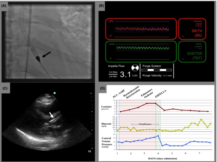 FIGURE 2  IMPELLA‐CP placement: IMPELLA‐CP was easily placed through the aortic valve and the pigtail end in proximity of the  apex of the left ventricle (A)