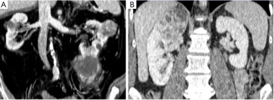 Figure 2 CT scan imaging of two cases planned for PN in whom a conversion to RN was performed because of intraoperative detection of  multiple tumors with perirenal fat involvement (A) and hilar tumor invasion (B)