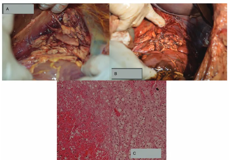 Figure 1. (A and B) Gross examination of adrenal lodges showing the presence of bilateral (respectively A: right; B: left) ﬁbrino-hemorrhagic deposition; (C) Microscopic examination of adrenal gland showing diffuse micronodular hyperplasia associated with 