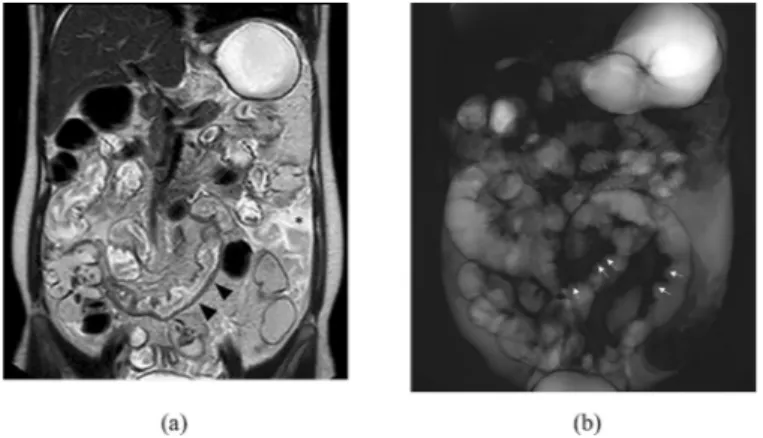 Fig.  1 – Coronal  T2-weighted  half-Fourier acquisition single-shot turbo-spin-echo  scan (a)  showing a mild thickening of a  distal ileal loop  (  black arrowheads )  and free  intraperitoneal fluid (  asterisk )