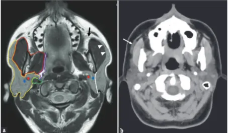 Figure 1: (a) T1‑weighted magnetic resonance axial scan showing the anatomy of the parotid region