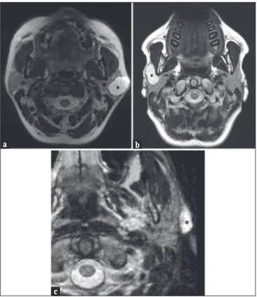 Figure  3:  A  56‑year‑old  male  patient  with  a  huge  swelling  of  the 