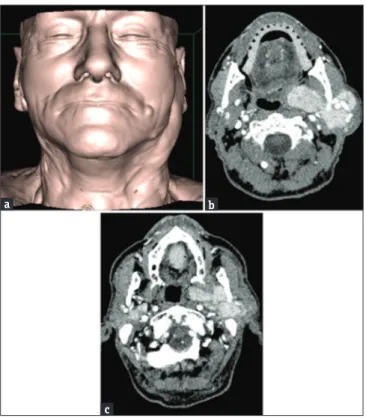 Figure 9: (a) A 58‑year‑old male postsurgical recurrences in the site 