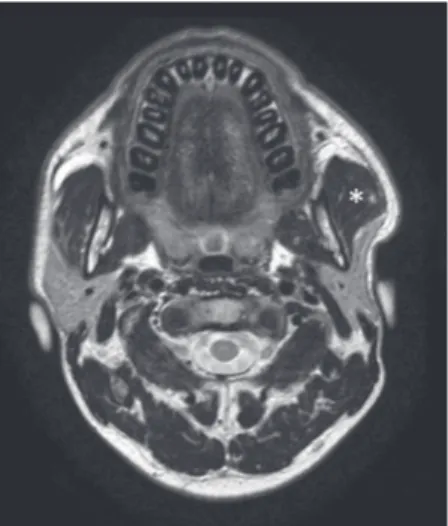 Figure  10:  A  37‑year‑old  female  patient  with  swelling  of  the  left 