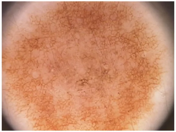 Figure 2. A typical dermoscopy image of a skin nevus. 