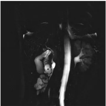 FIGURE 2  Coronal tick‐slab 3D T2‐w TSE RARE image  clearly demonstrates the DDC (asterisk) within the duodenal lumen