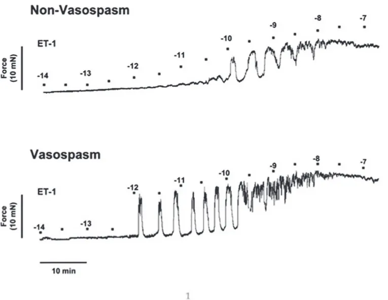 Figure 1. Experimental myograph record of isolated rat basilar arteries incubated with 5% CSF from patients with SAH with and without vasospasm