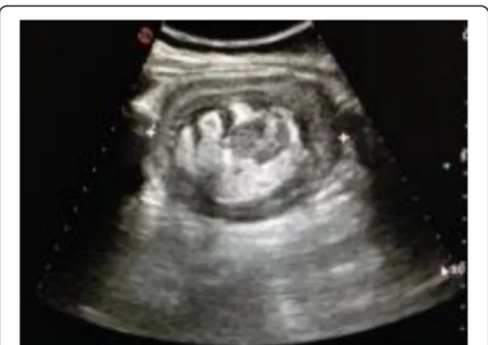 Fig. 1 Abdominal ultrasound noted an intussusception, giving the typical “target” sign