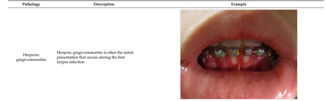 Table 1. Herpes oral and systemic manifestations.
