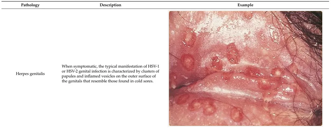 Figure 3. Herpes genitalis manifestations, licence CC BY-SA 3.0, adapted for gentle 