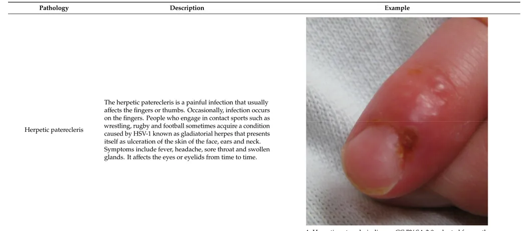 Figure 4. Herpetic paterecleris, licence CC BY SA 3.0, adapted for gentle concession of 