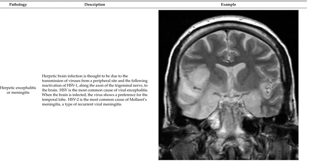 Figure 5. Herpes simplex encephalitis, licence CC BY 3.0, adapted with concession of 