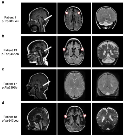 Fig. 2 Brain imaging in 4 individuals with GRIA2-related DEE and brain and cerebellar atrophy