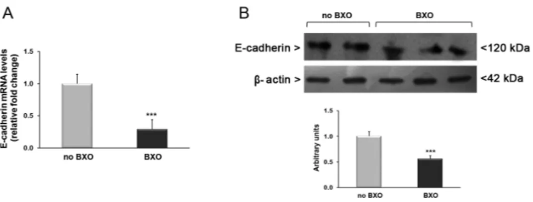 Figure 4. Analysis of expression levels of E-cadherin in foreskin tissues from patients with (n = 15) 