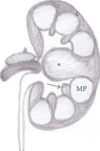 Figure 1: Anatomical drawing of a hypertrophied column of Bertin (asterisk). Normal renal column (arrow); medullary pyramid (MP); renal cortex (c).