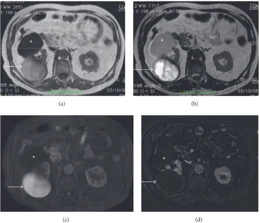 Figure 12: Hemorrhagic cyst. MRI GE T1-weighted (a), TSE T2-weighted (b), contrast-enhanced GE T1-weighted fat-sat (c), and subtracted postcontrastographic (d) image