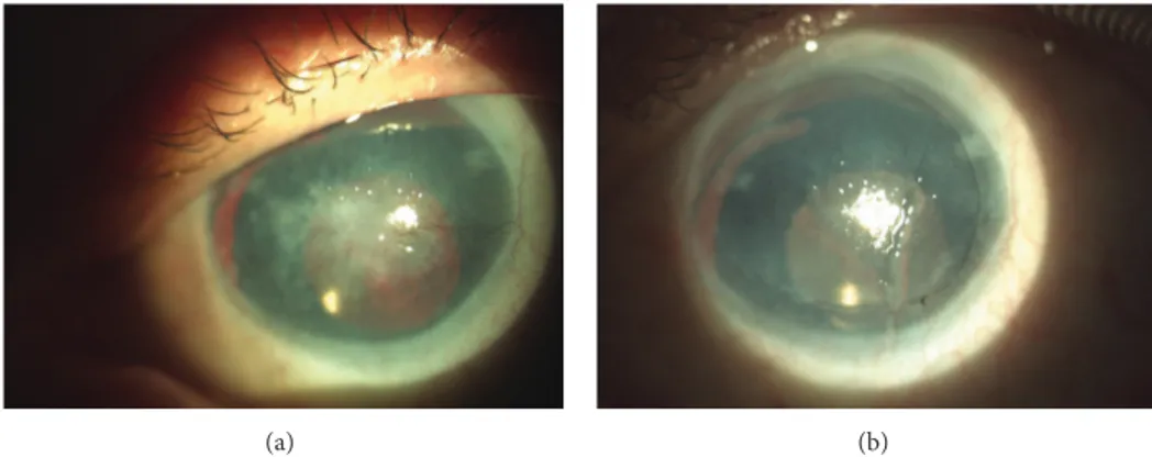 Figure 3: (a) and (b) Aniridia patient, 49-year-old man, who underwent cataract surgery 5 years before COMET