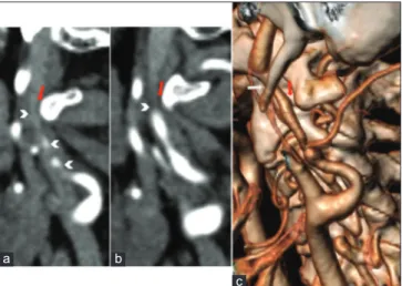 Figure  1: Computed tomography angiography examination.  (a and b) Sagittal multiplanar reconstruction showing the left  internal carotid artery (ICA) dissection with severe vessel stenosis  (arrowheads)
